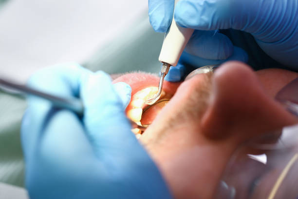 Best Emergency Tooth Extraction in Inwood, FL